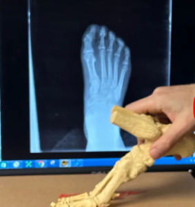 Fit Foot U: w/ Dr. Pearl: Sesamoid Stress Reaction in Foot